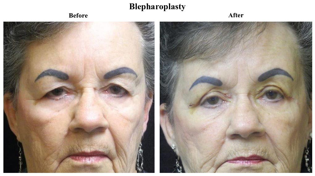 Before treatment and After Blepharoplasty treatment