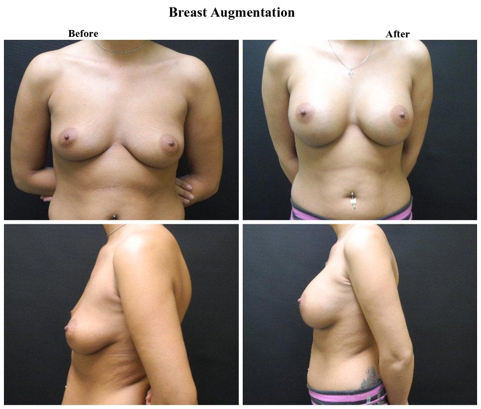 Before treatment and After Breast Augmentation treatment
