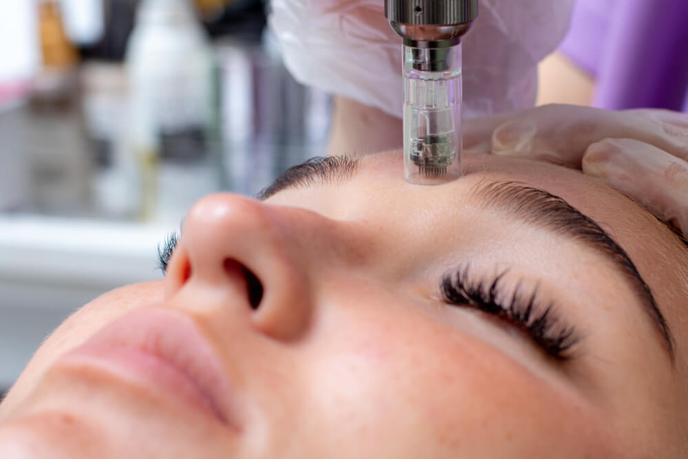 Fractional microneedle facial therapy