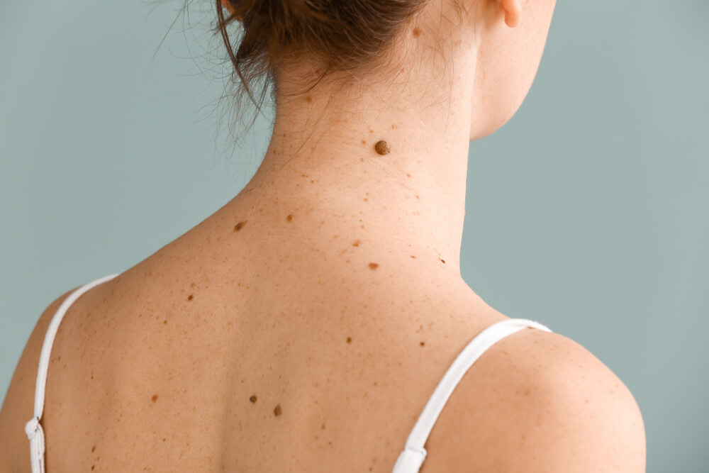 Young woman with moles