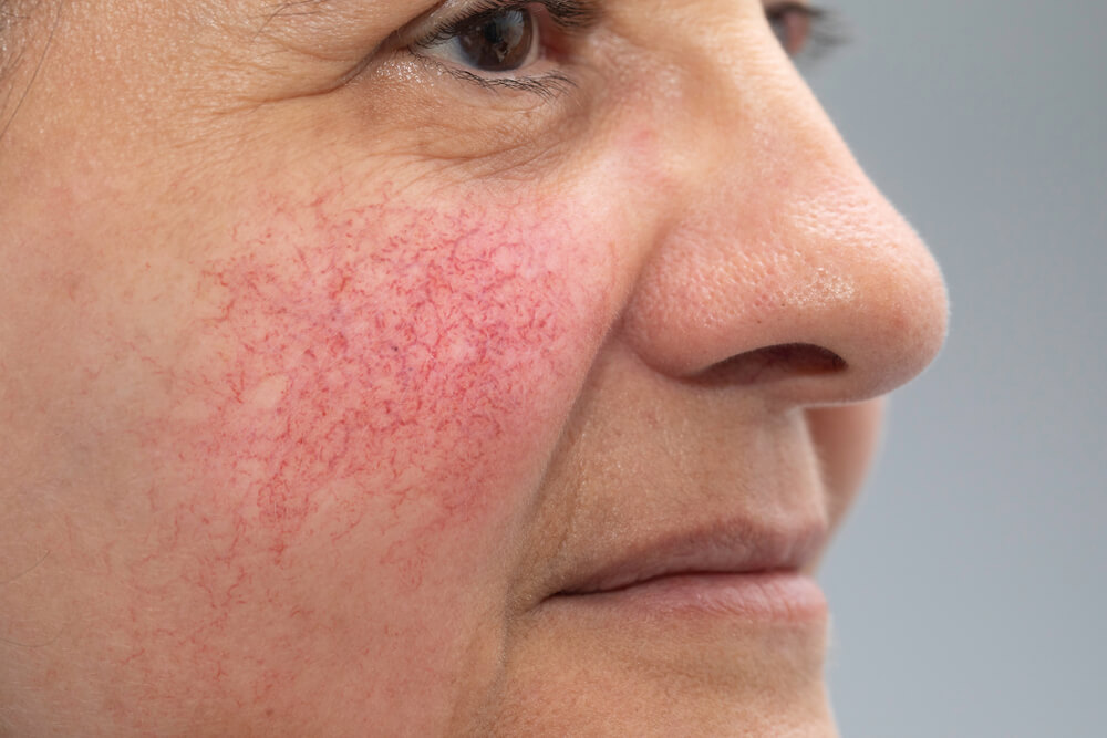 mature woman, red and blotchy cheeks are seen in detail