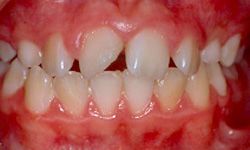 Intra-oral picture of teeth