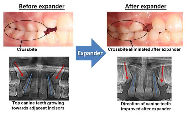 before and after expander
