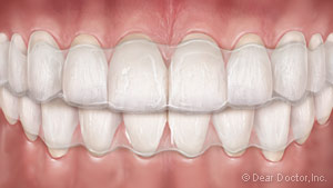 clear-aligners