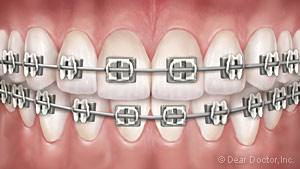 metal-braces