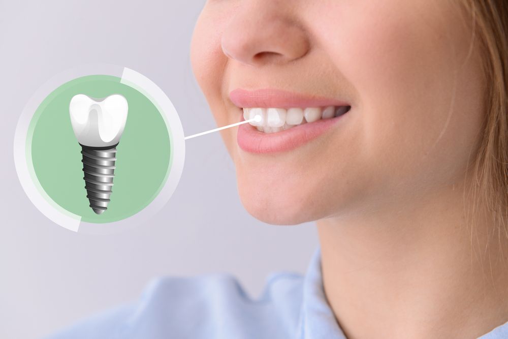 What is a Dental Impression?  Needham, Bedford, Franklin, MA