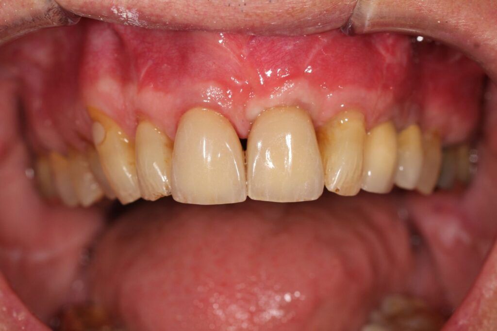 DS 8 crown 9 implant