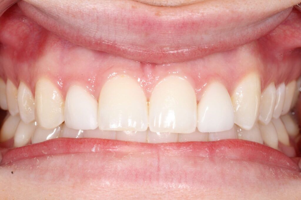 KM veneers after