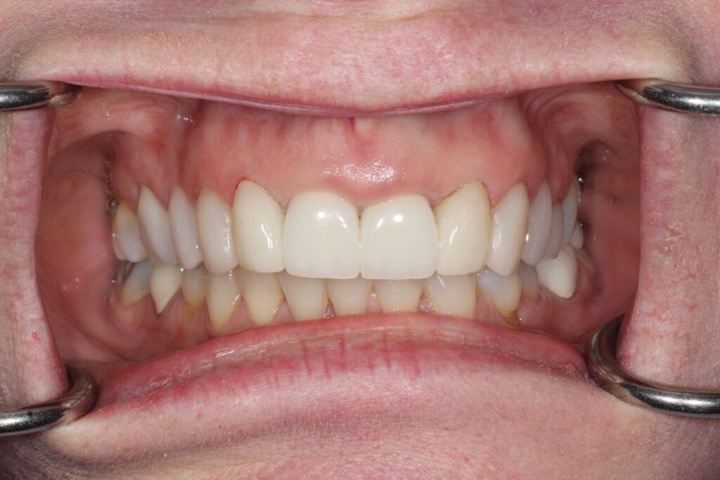 SC veneers after treatment