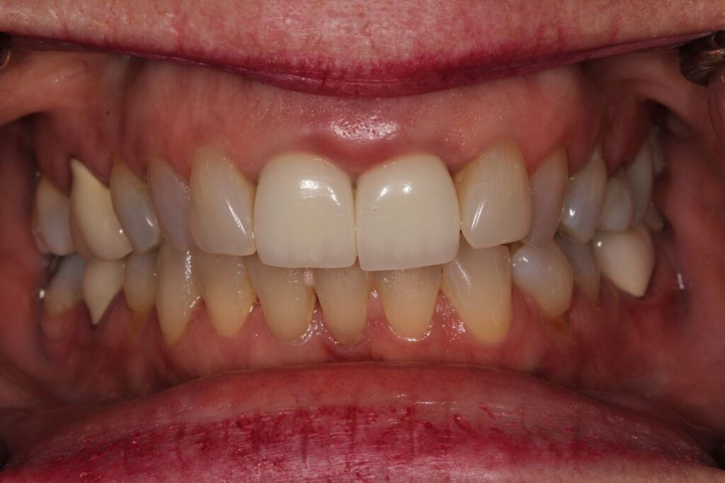 SC veneers before treatment