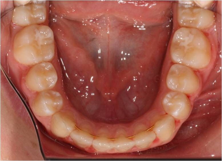 Floor of the mouth and lingual veins