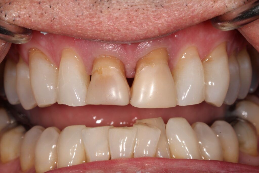 WZ crowns before treatment