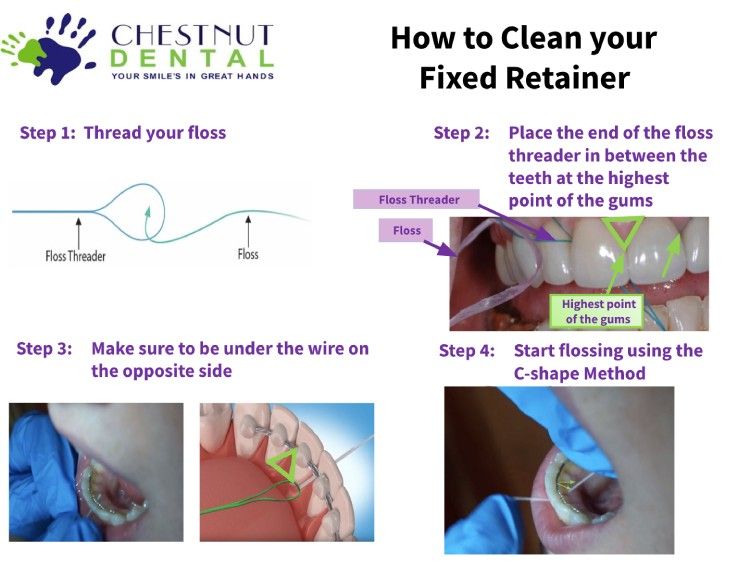 how to floss your fixed retainer pdf