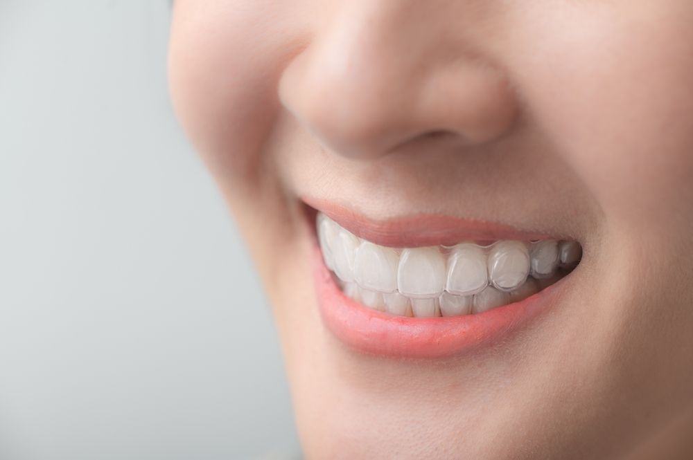 close up of invisalign clear aligner
