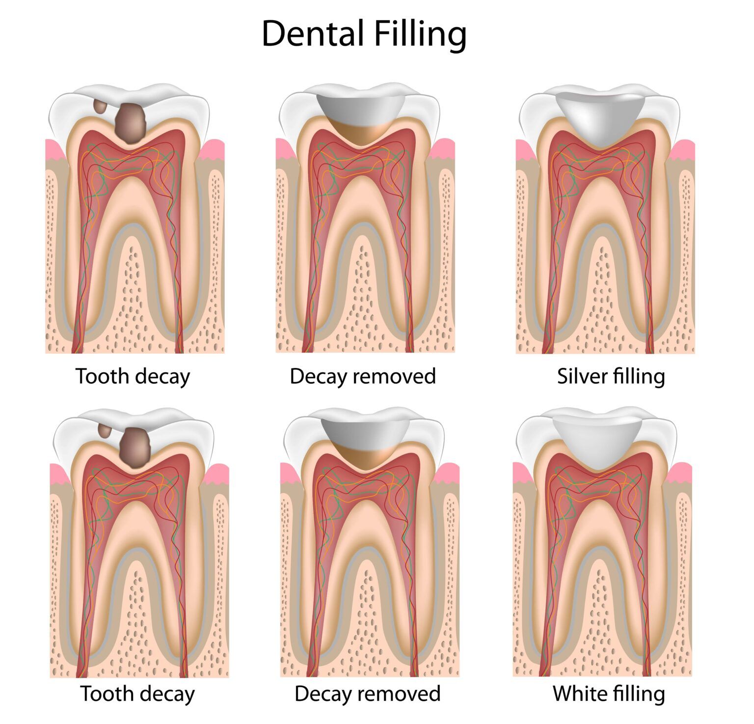 What are Dental Fillings Made Of? Needham, Bedford, Franklin, MA
