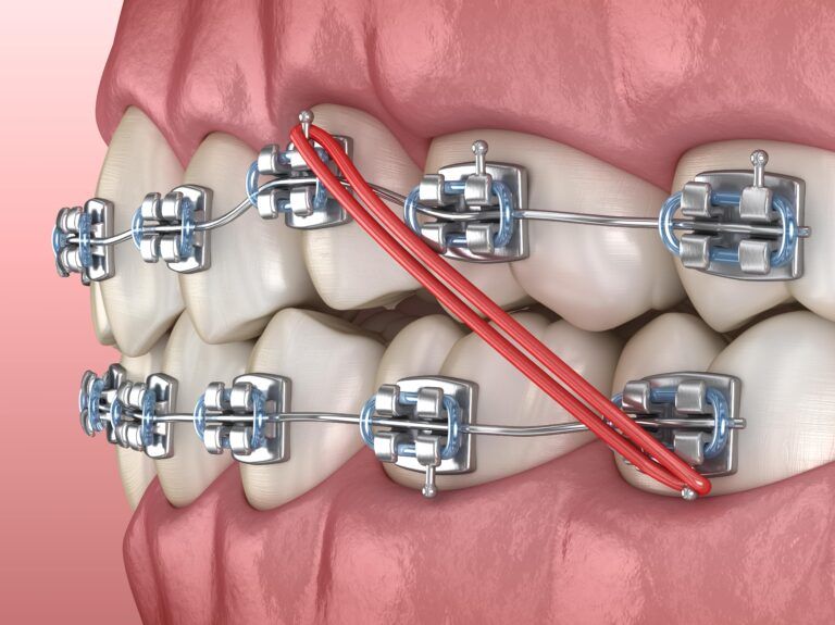 orthodontic elastics on braces