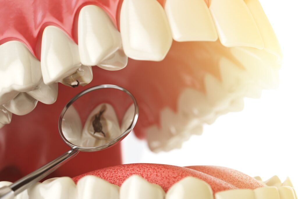 dental cavity shown in dental mirror. vector image