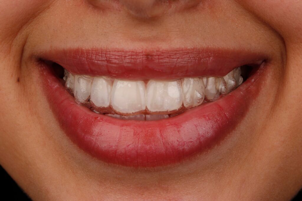 Close up view of a woman wearing invisalign braces
