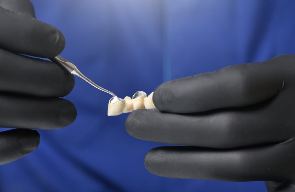 prosthodontist applying cement to dental bridge