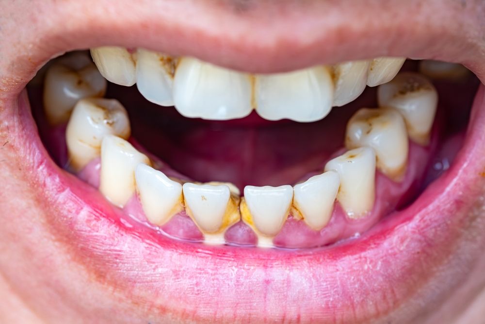 The effects of smoking and tobacco use on your teeth and gums