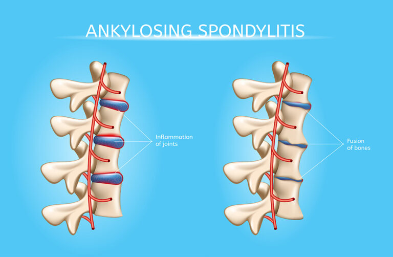 Ankylosing Spondylitis