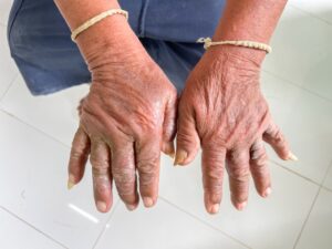 Scleroderma Awareness Month