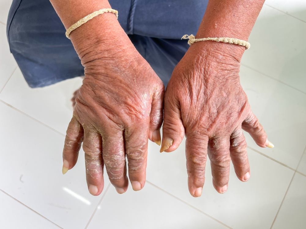 Scleroderma Awareness Month