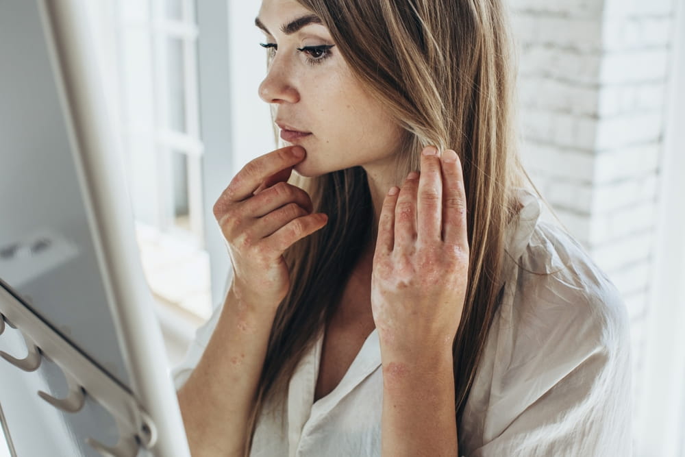 Psoriasis. Acute psoriasis on the knees, body, elbows is an autoimmune,