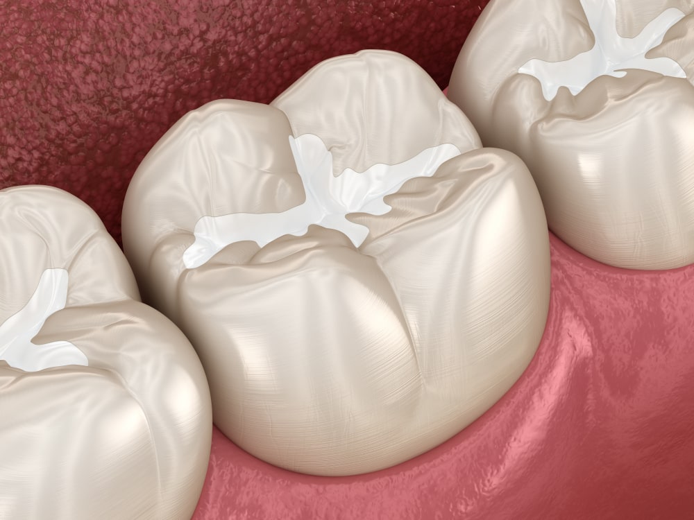 Molar Fissure dental fillings