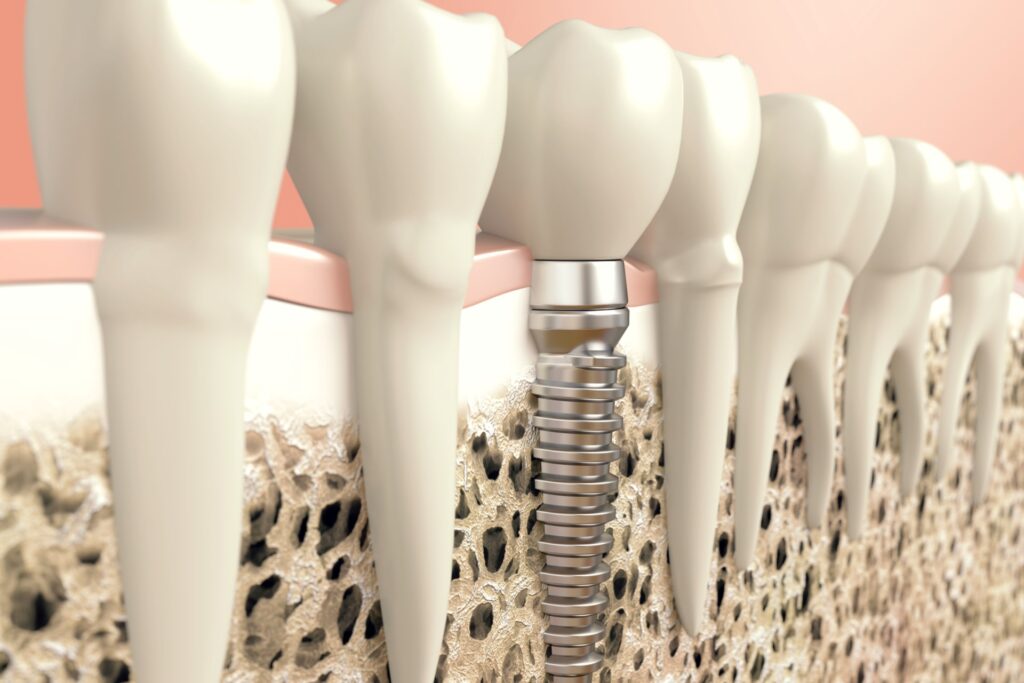 Dental implant