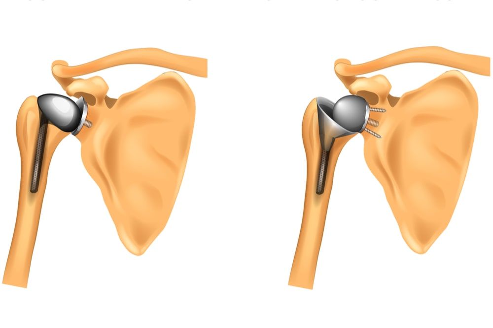 the types of prosthesis of shoulder