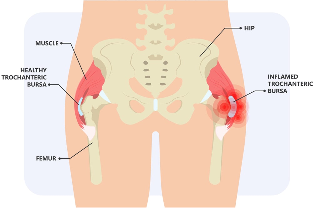 Hip pain knee heel cuff bone gout drug Feet bursa joint elbow treat tear drain shots