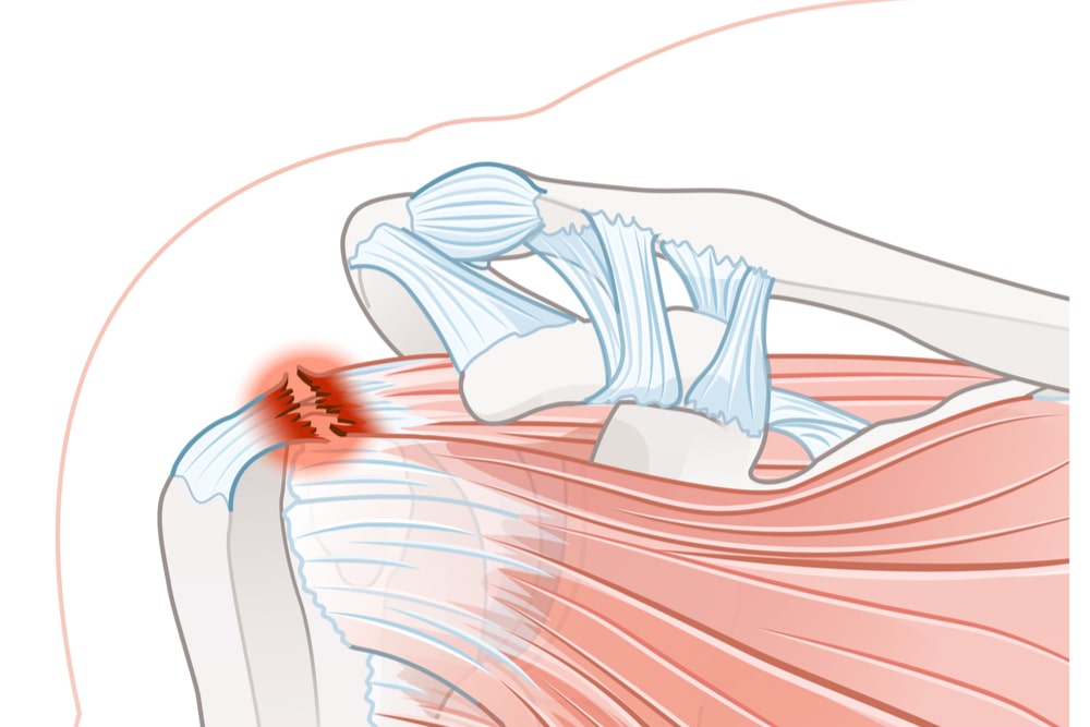 Shoulder pain. Rotator cuff tear