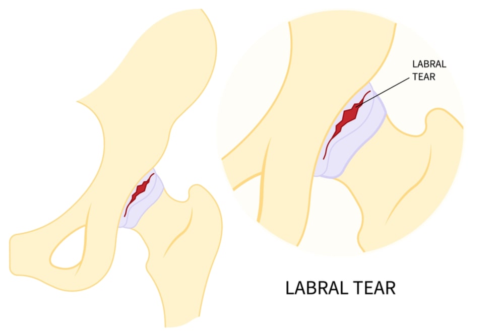 hip bone Pain range of motion groin head tear Treat joint thigh femur injury spurs socket lesion