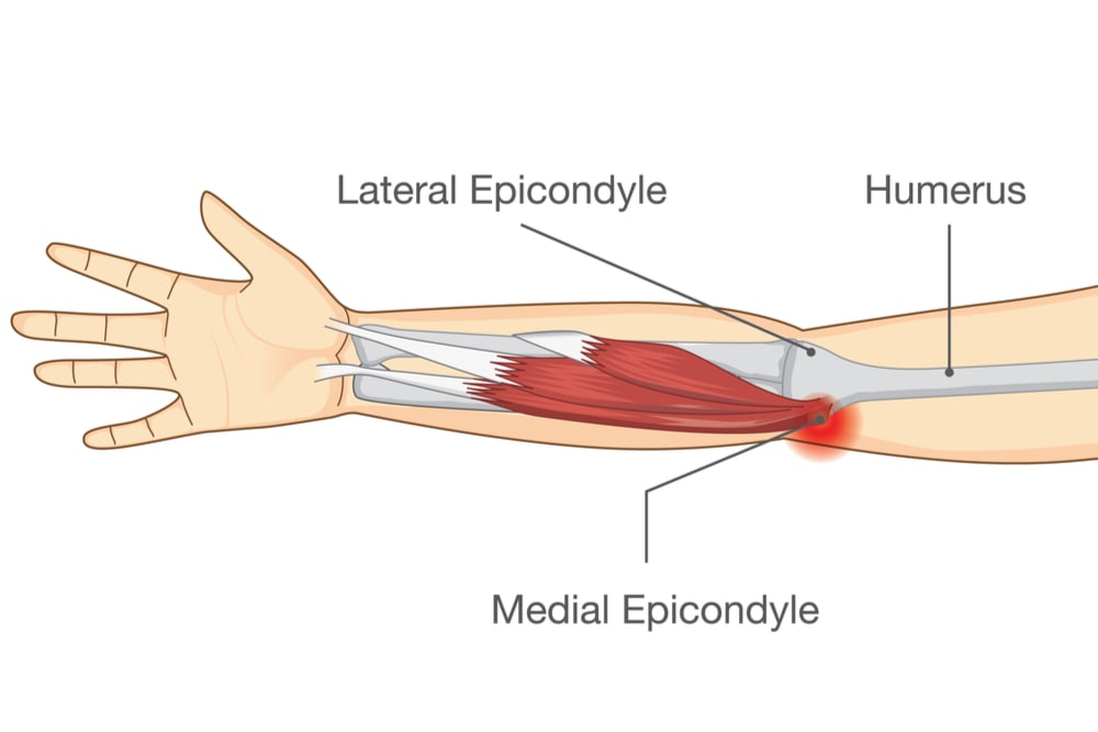 Lateral Epicondylitis Rockwall TX Manoj Reddy Lateral Epicondylitis Rockwall TX Manoj Reddy