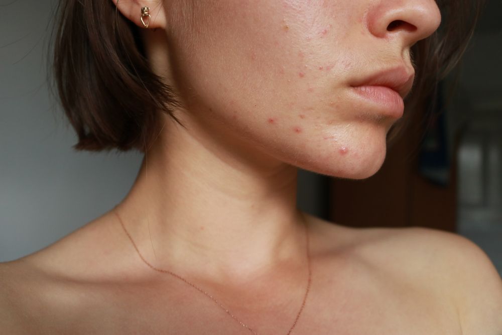 Hormone Imbalance causing acne
