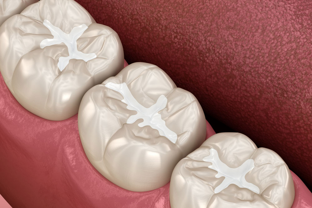 Molar Fissure dental fillings, Medically accurate 3D illustration of dental concept