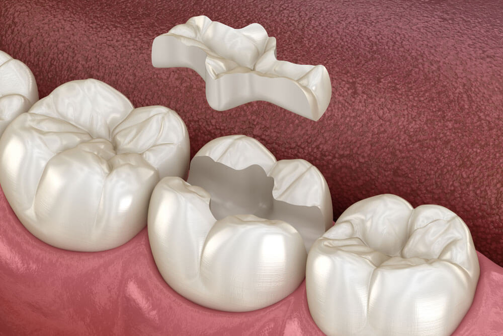 Inlay ceramic crown fixation over tooth. Medically accurate 3D illustration of human teeth treatment