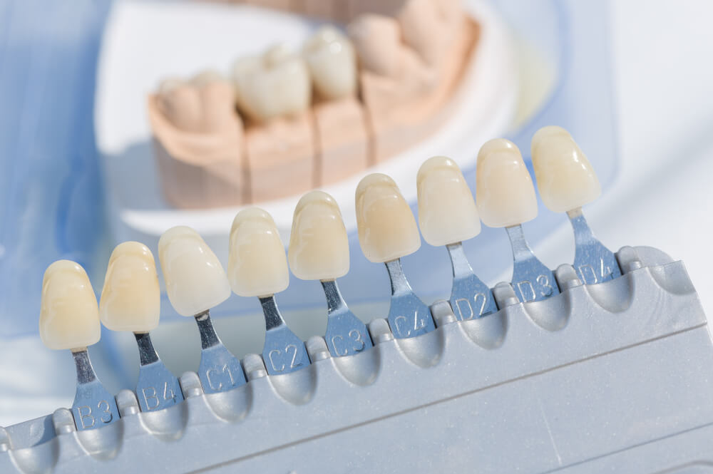 Close up of checking veneer of artificial dentition on a dental imprint in a dental laboratory