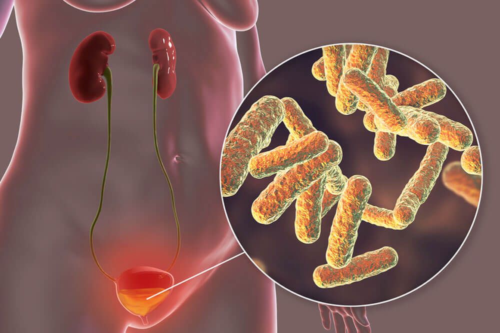 Cystitis, bacterial infection of urinary bladder, conceptual 3D illustration showing bacteria in urine