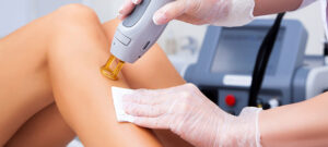 Laser hair removal