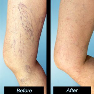 Erin Alouf at D'Cate Aesthetics & Medicine provide the best Laser Vein removal services in Roanoke, VA