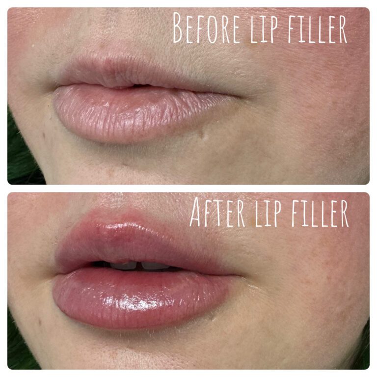 Before and after lip filler treatment showing the enhancement of lip volume and smoothness.