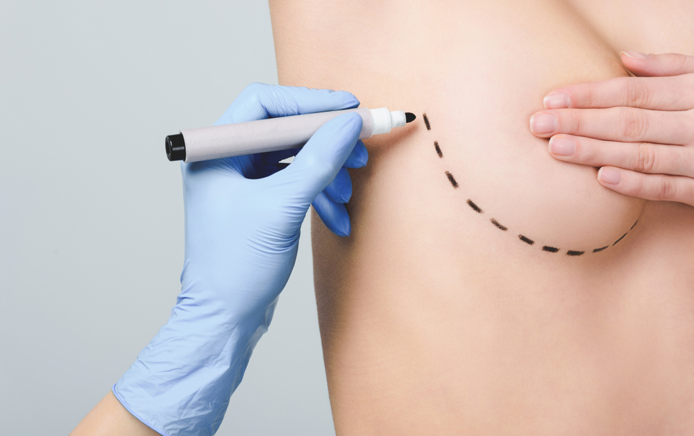 Doctor marking lines under breast