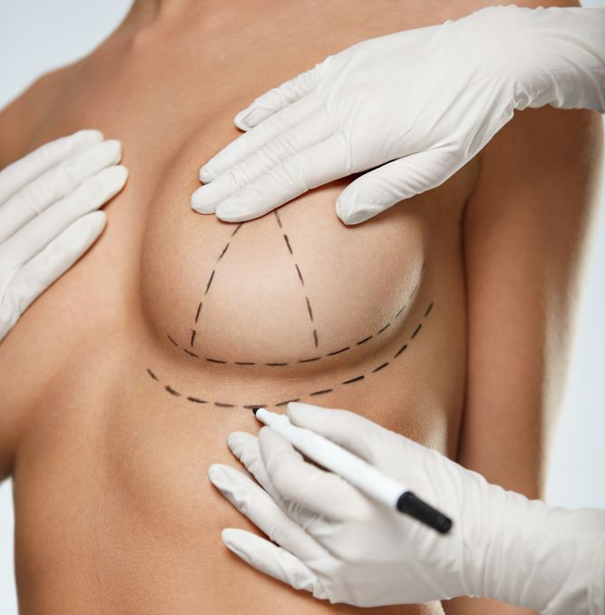 Beautician marks a woman's breast for a Breast Lift