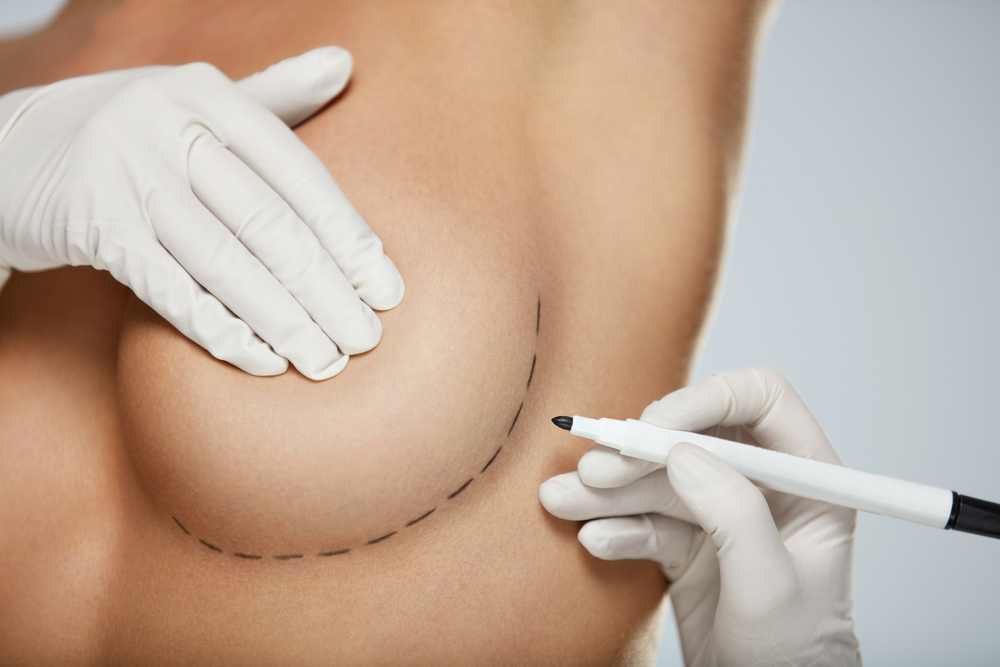 Breast Lift vs. Breast Augmentation: Which Is Best For Me?