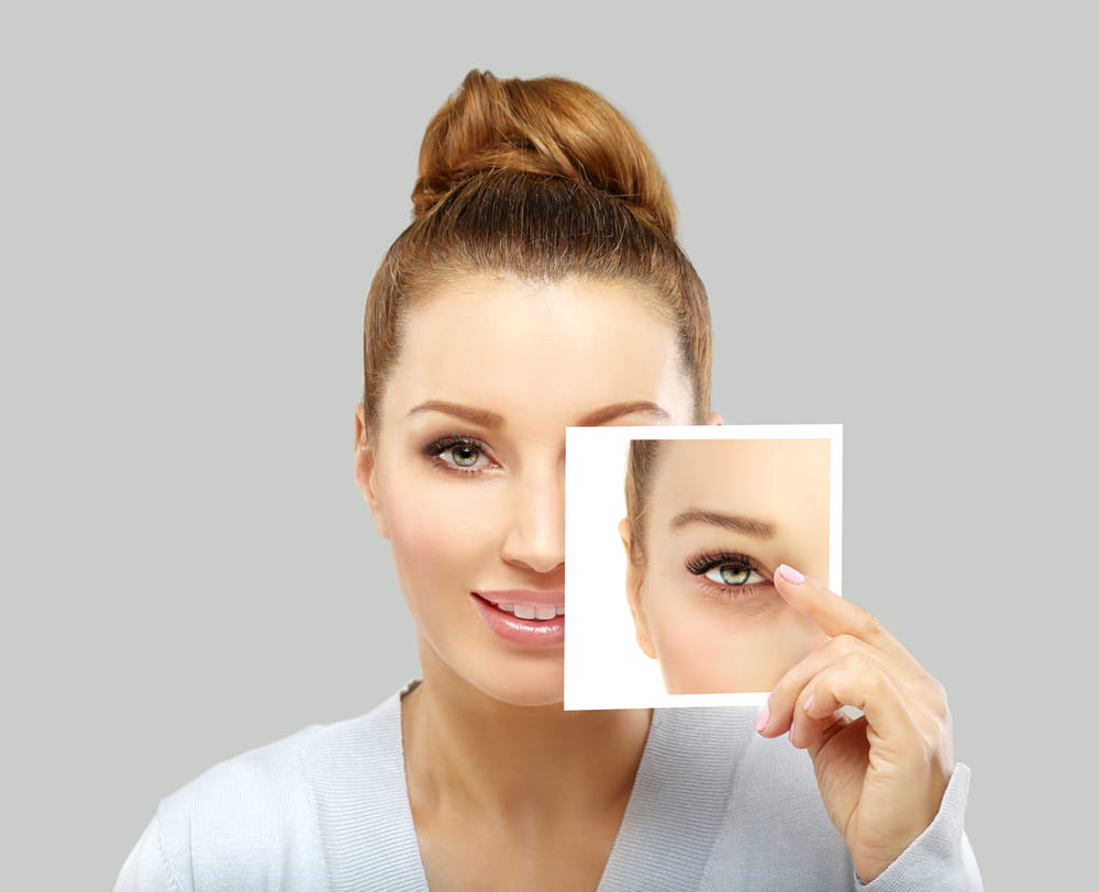 Lower Eyelid Blepharoplasty.