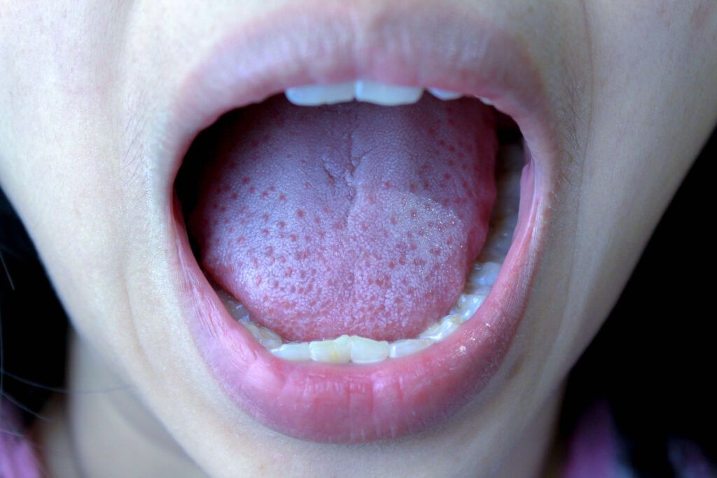 Person with their mouth open to check for Oral Cancer