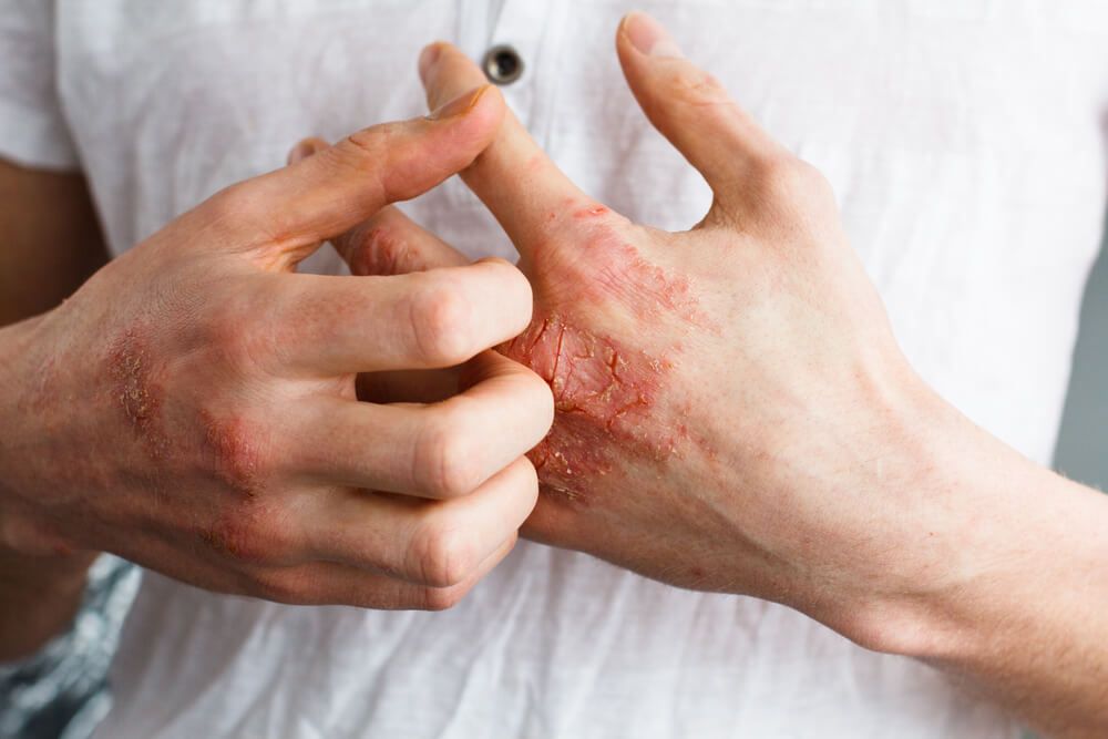 The problem with many people - eczema on hand