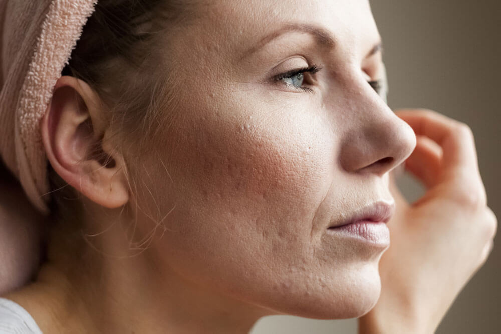 Macro shot of young woman's cheek with typical problem with acne